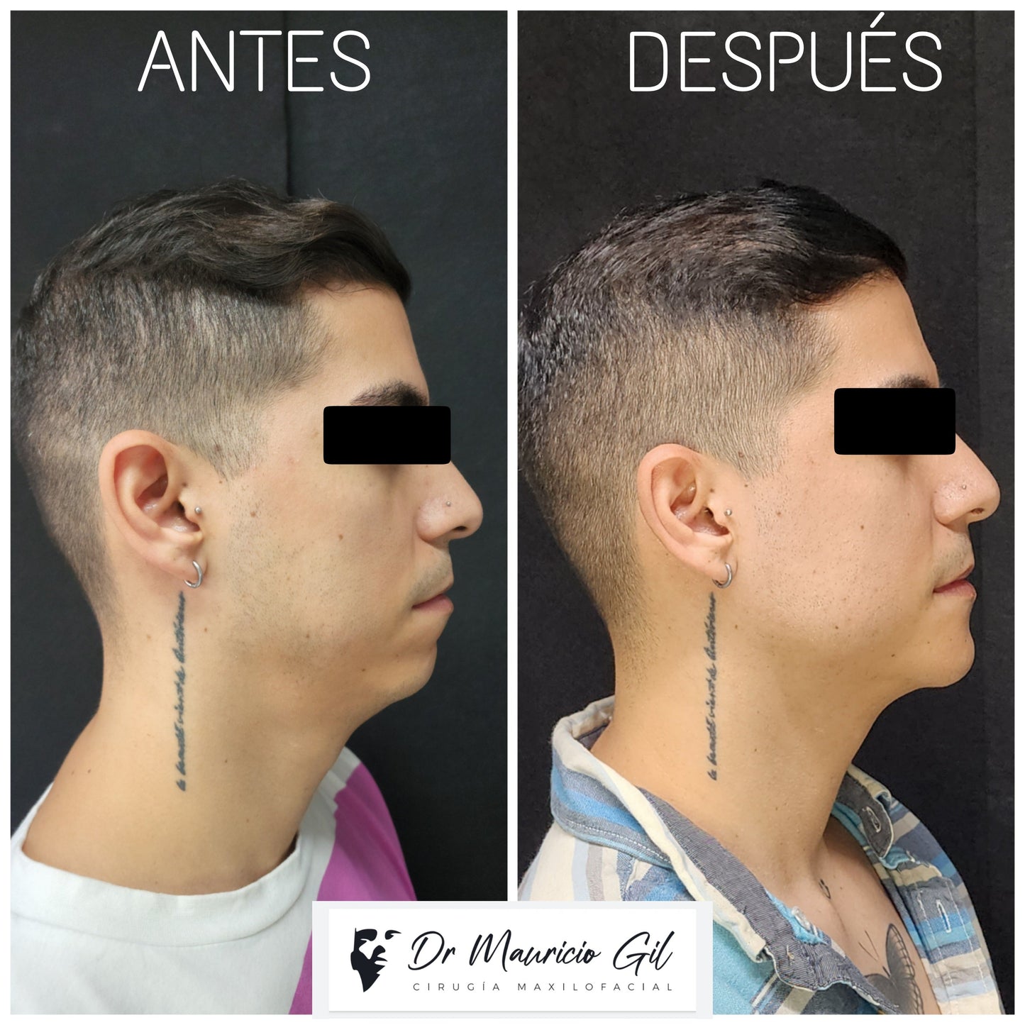 Genioplasty/Mentoplasty