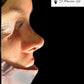 Rhinoplasty