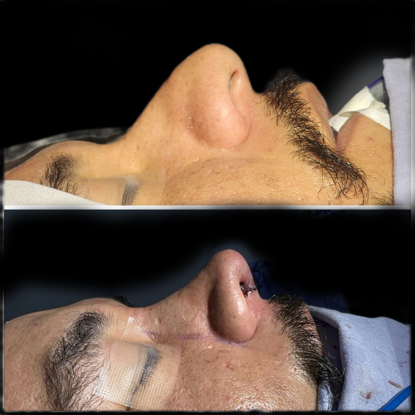 Rhinoplasty