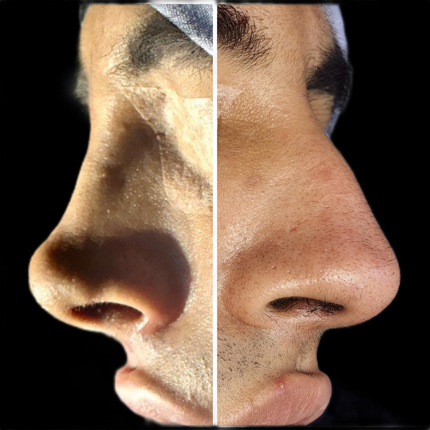 Rhinoplasty