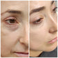 Blepharoplasty