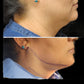Chin Liposuction