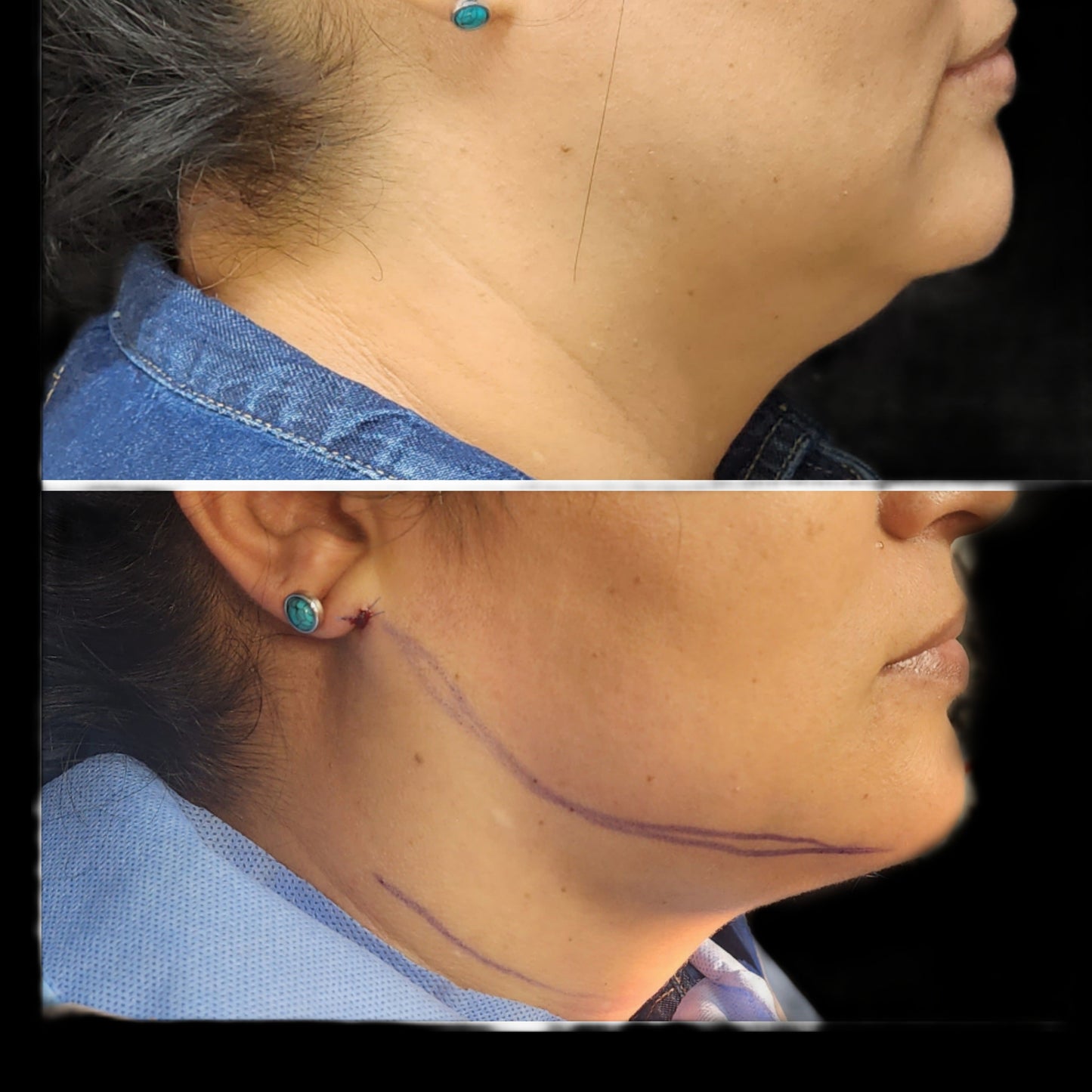 Chin Liposuction