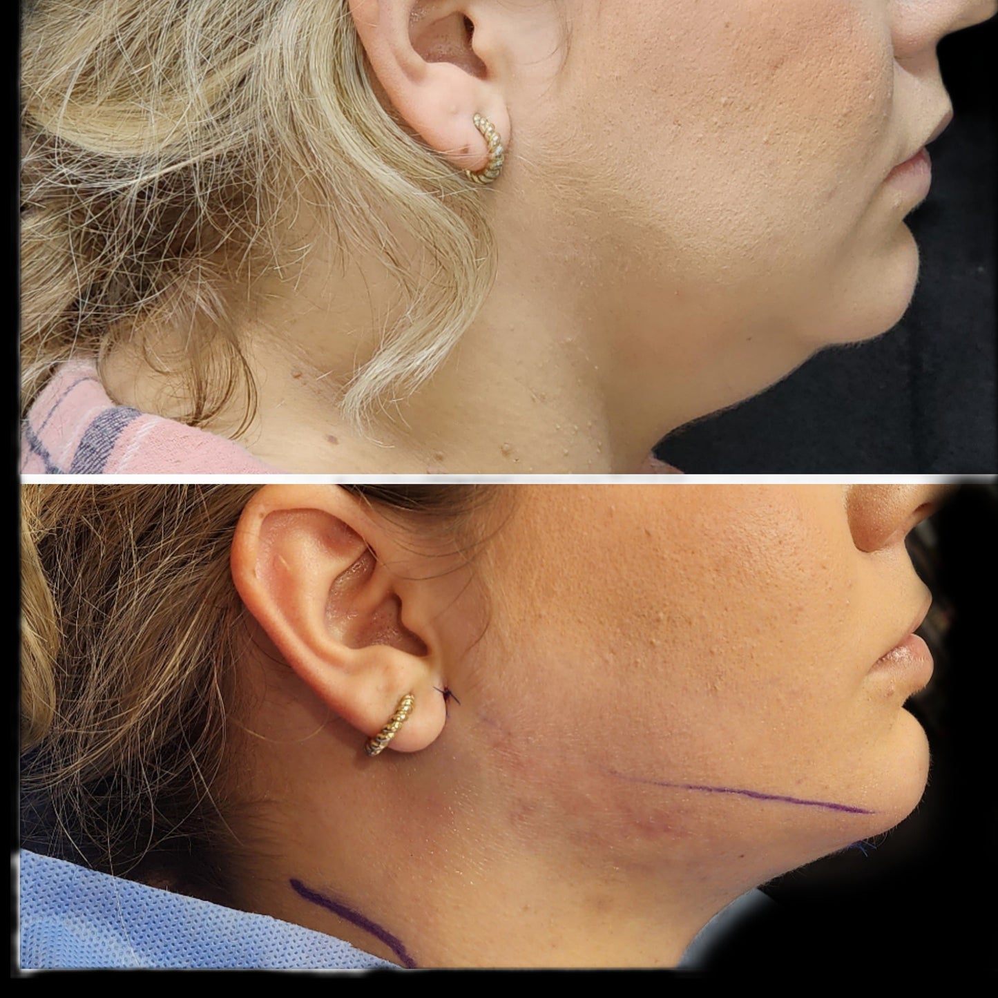 Chin Liposuction