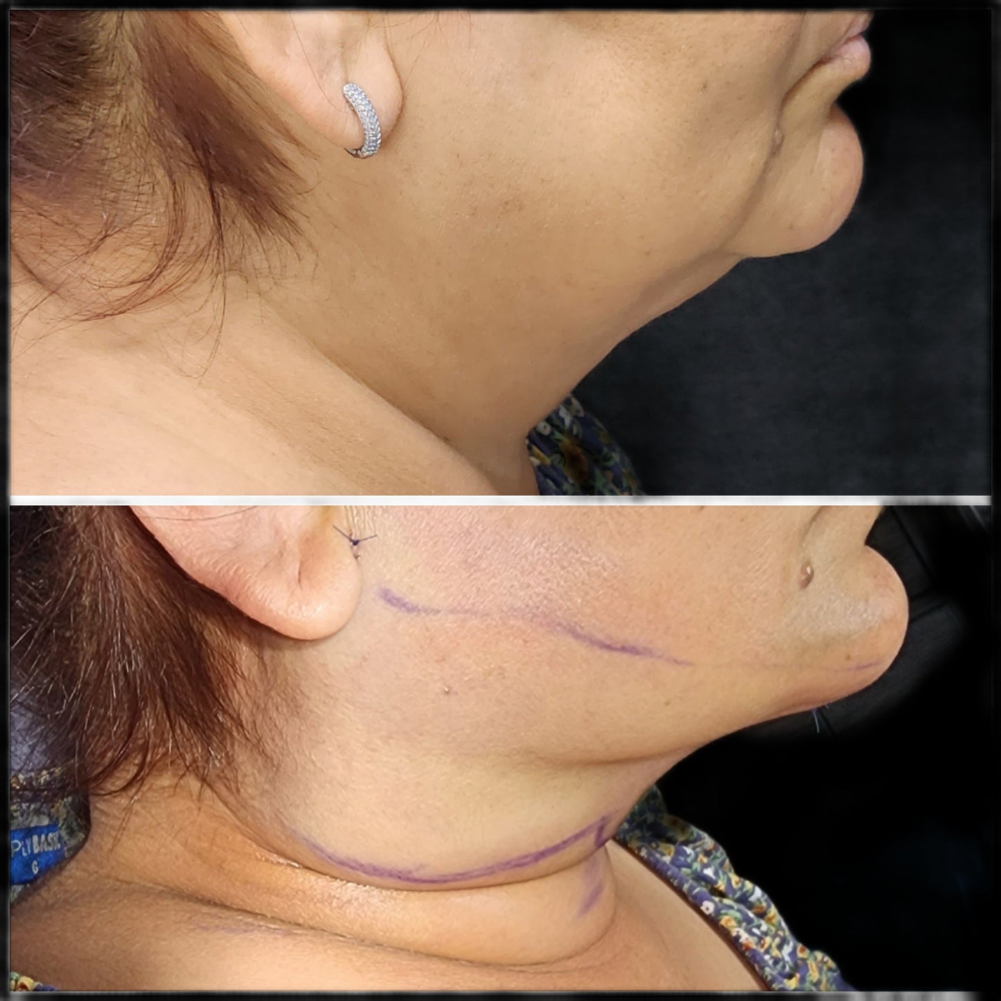 Chin Liposuction