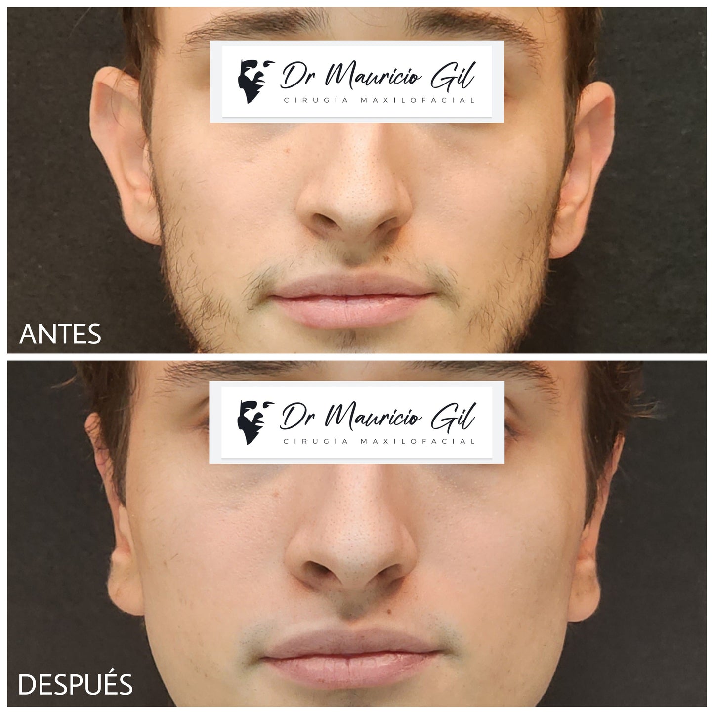 Otoplasty