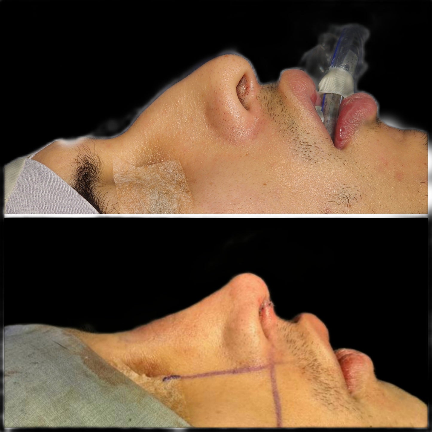 Rhinoplasty