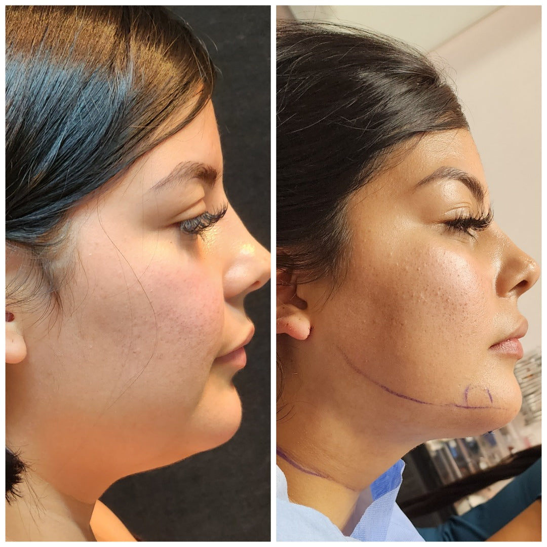 Chin Liposuction