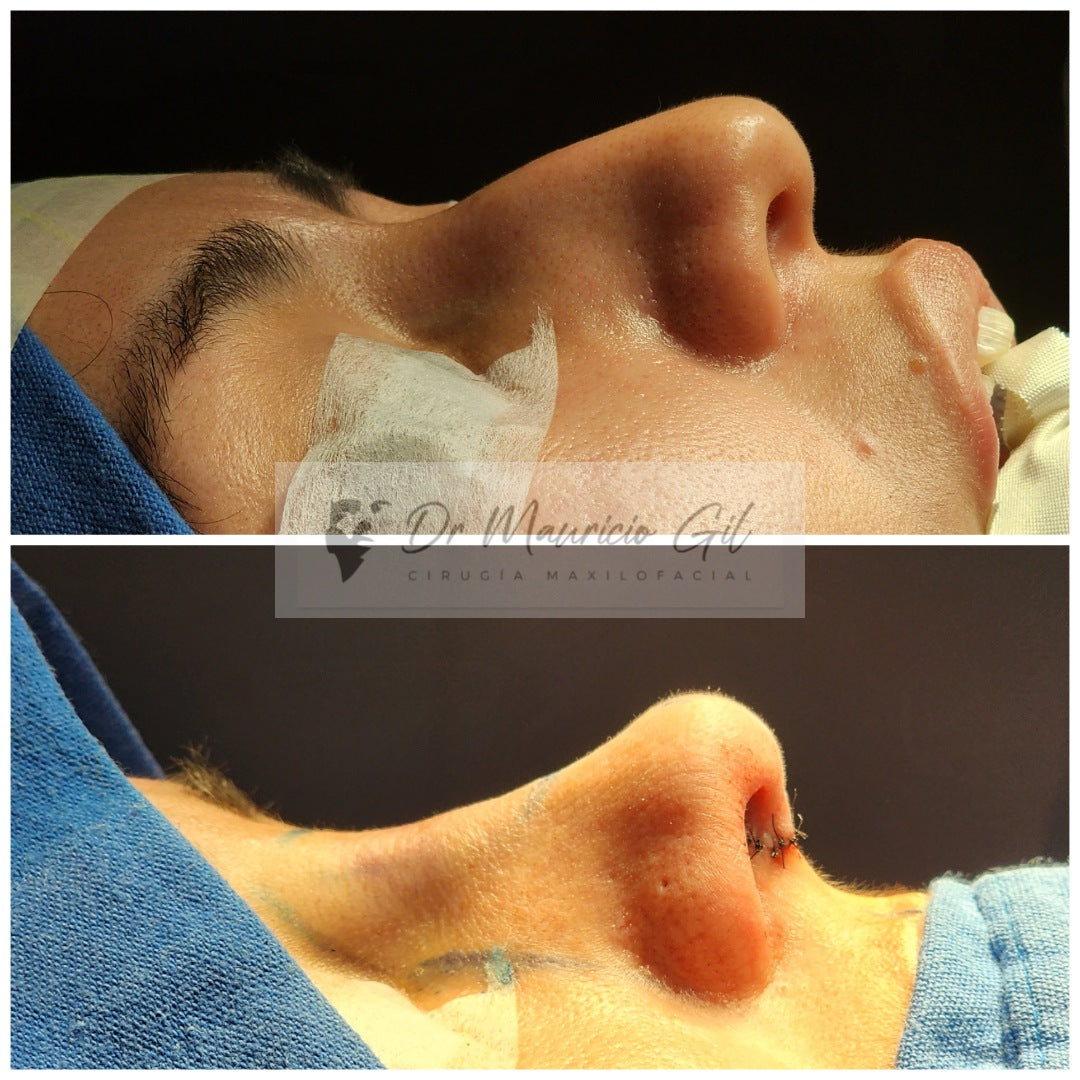 Rhinoplasty