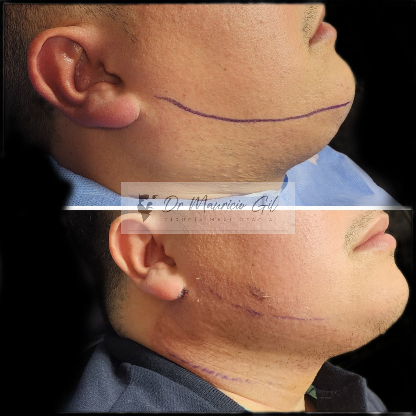 Chin Liposuction