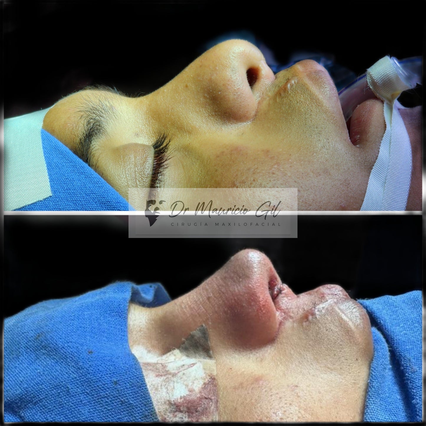 Rhinoplasty