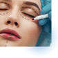 Blepharoplasty