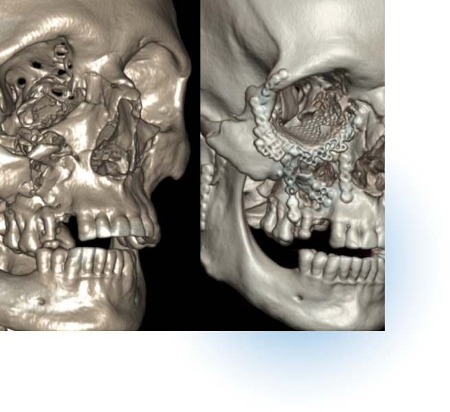 Facial Trauma