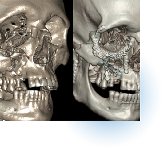 Facial Trauma