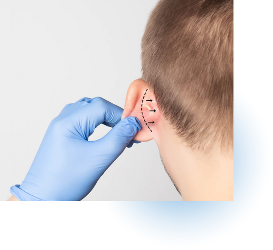Otoplasty
